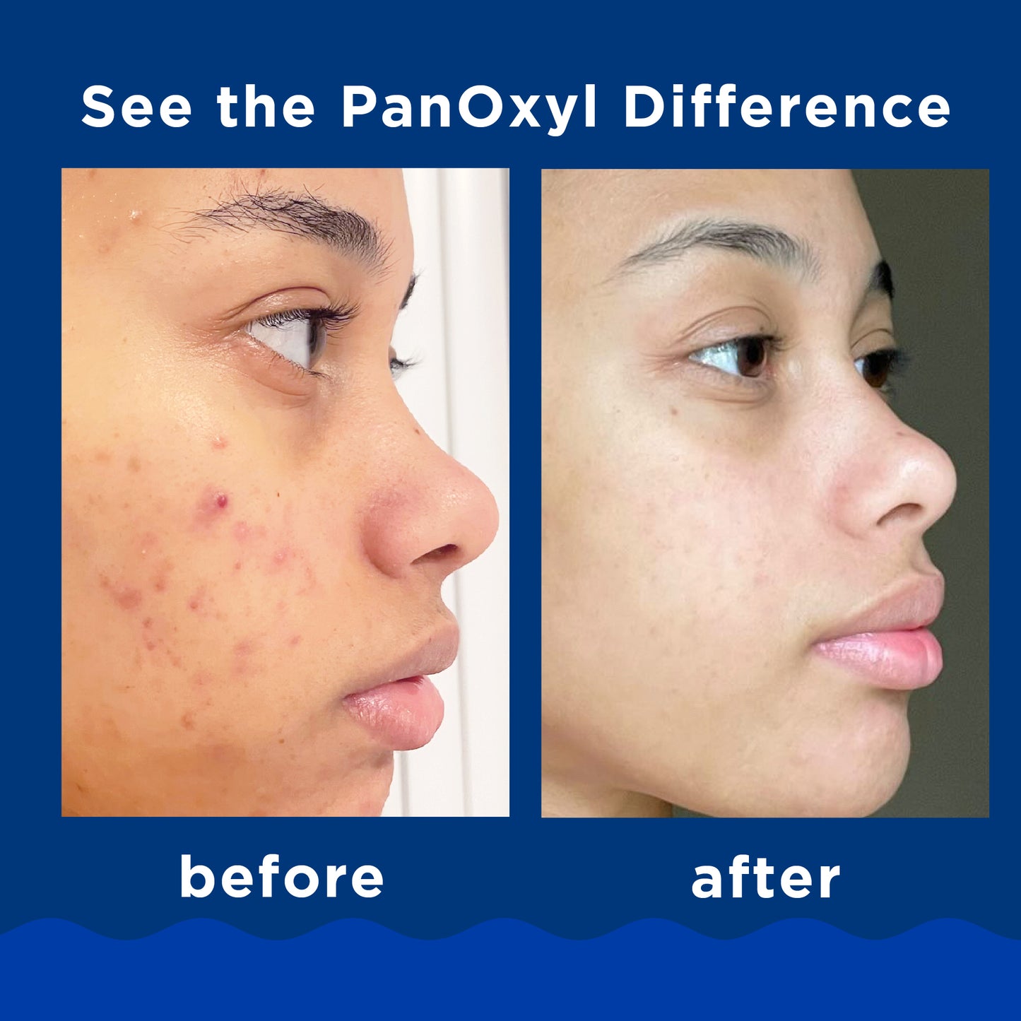 Acne Foaming Wash Benzoyl Peroxide 10% - PanOxyl